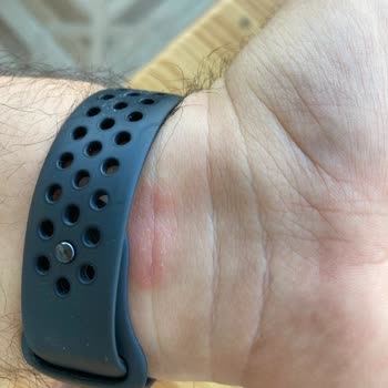 Apple Watch Kordonu Yara Yapıyor