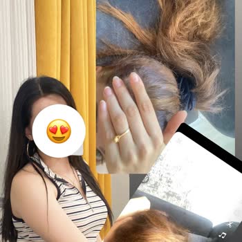 Berat Bozdoğan Hair İhmali İle Saç Yanması