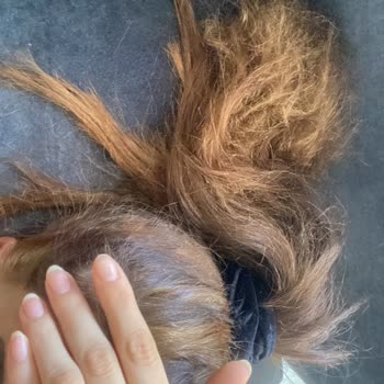 Berat Bozdoğan Hair İhmali İle Saç Yanması