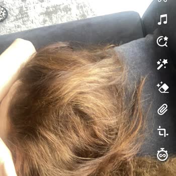 Berat Bozdoğan Hair İhmali İle Saç Yanması