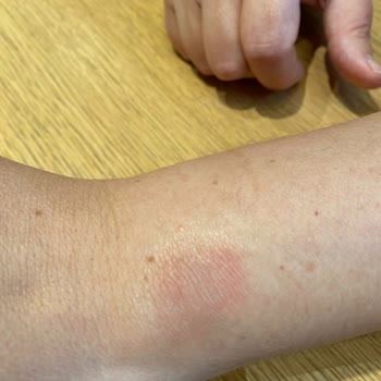 Apple Watch 8 Bileğimi Yaktı