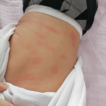 Dalin Şampuan Alerji Yapıyor.