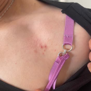 Penti'den Aldığım Sütyen Yara Yaptı!