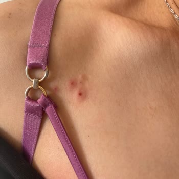 Penti'den Aldığım Sütyen Yara Yaptı!