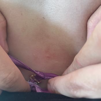 Penti'den Aldığım Sütyen Yara Yaptı!