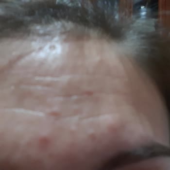 Day2day ALL Body Sivilce Şikayeti