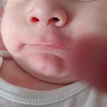 Hipp Organik Yulaflı Elmalı Sütlü Ürüne Alerji