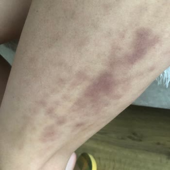 Lundbeck Fonksera'nın Korkunç Yan Etkileri