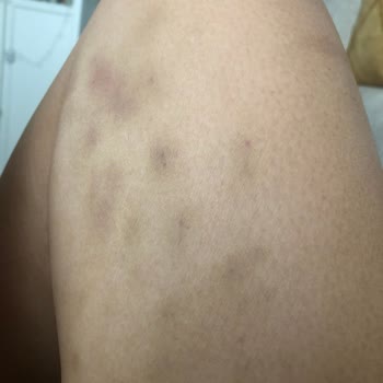 Lundbeck Fonksera'nın Korkunç Yan Etkileri