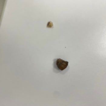 Domino's Pizza İlgisizliği Yüzünden Dişim Kırıldı.