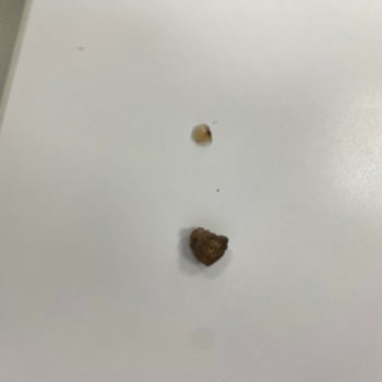 Domino's Pizza İlgisizliği Yüzünden Dişim Kırıldı.