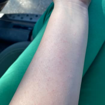 Rossmann İsana Üre Krem Alerji Yaptı