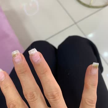 Queen Nail Ankara Protez Tırnak Mantar Olmuş!