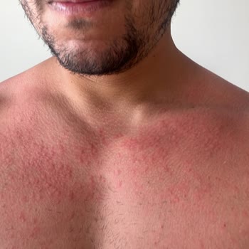 Nivea Güneş Kremi Alerji Yapıyor