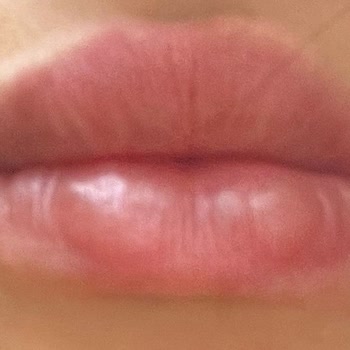 Bandırma Göz ( Op. Dr. Seher Kırar Poçan) Dudak Dolgusu