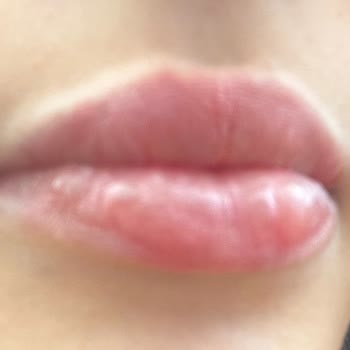 Bandırma Göz ( Op. Dr. Seher Kırar Poçan) Dudak Dolgusu