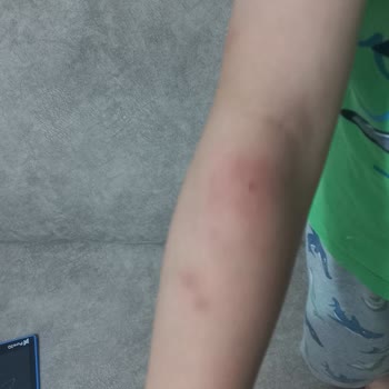 İzmir Büyükşehir Belediyesi Böcek Ve Sivri Sinekler İçin İlaçlama Eksikliği