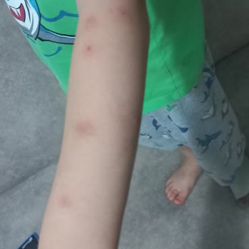 İzmir Büyükşehir Belediyesi Böcek Ve Sivri Sinekler İçin İlaçlama Eksikliği