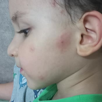 İzmir Büyükşehir Belediyesi Böcek Ve Sivri Sinekler İçin İlaçlama Eksikliği