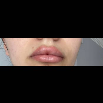 New Life Estetic Gayrettepe Dudak Dolgusu Deneyimimden Memnun Kalmadım