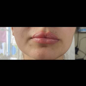 New Life Estetic Gayrettepe Dudak Dolgusu Deneyimimden Memnun Kalmadım