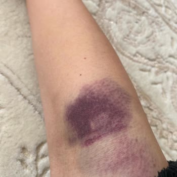 Medical Park Kan Alma Problemi