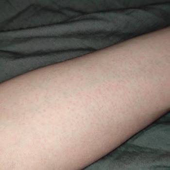 Cire Aseptine Güneş Koruyucu Kızarıklık Yapıyor