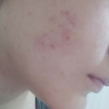 The Purest Solutions The Purest Kırmızı Peeling