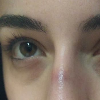 Benri Marka Burun Bandı Burnumu Morarttı