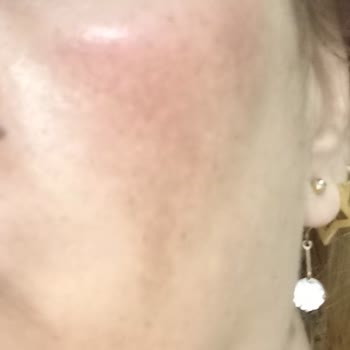 Loreal Paris Ürünü Cildimi Cayır Cayır Yaktı