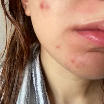 SHE Estetik Başakşehir Şubesi Klasik Cilt Bakımı Şikayeti