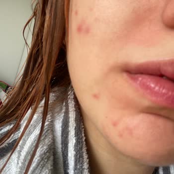 SHE Estetik Başakşehir Şubesi Klasik Cilt Bakımı Şikayeti