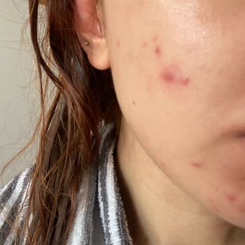 SHE Estetik Başakşehir Şubesi Klasik Cilt Bakımı Şikayeti