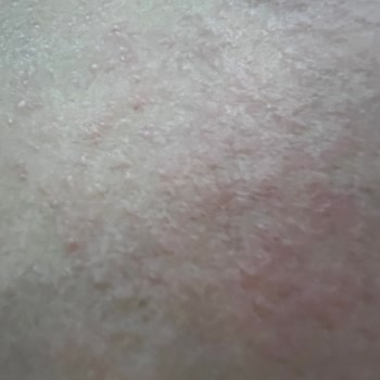 Eda Taşpınar Bronzlaştırıcı Alerji Yapması