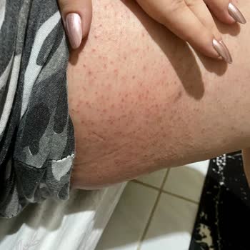 Sebamed Pişik Önleyici Krem Alerji Yaptı