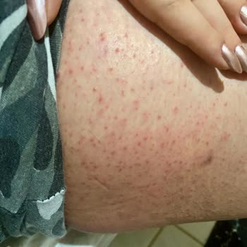 Sebamed Pişik Önleyici Krem Alerji Yaptı