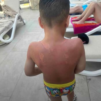 Dr. Öz Klinik Güneş Kreminden Yandı