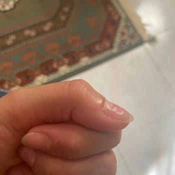 Nascita Takma Tırnak Kabusu