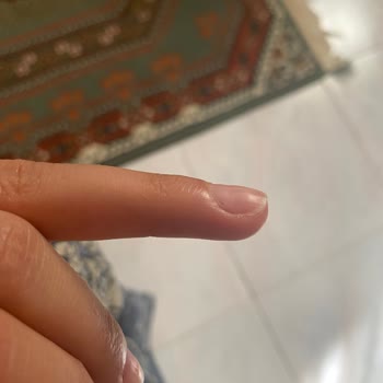 Nascita Takma Tırnak Kabusu