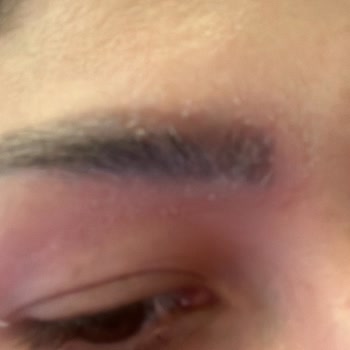 Serap Çınar Akasya Kaş Vitamin Sorunu