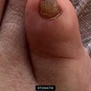 Pronail Marmara Forum Medikal Pedikür Ve Batık!