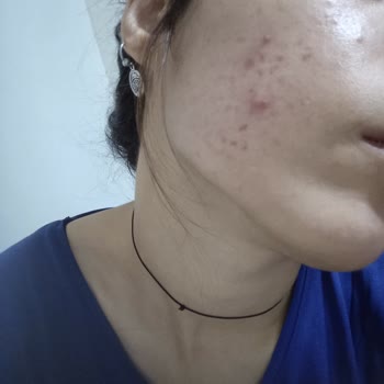 Avene Köpük Temizleyici Akne Ve Komedon Yapıyor