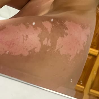 Eda Taşpınar Bronzlaştırıcı Yanık Yarattı