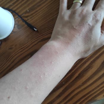 İncia Doğal Sinek Kovucu Sprey Alerji Yaptı