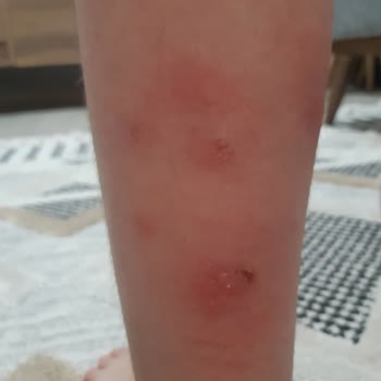 İzmir Balçova Belediyesi Sinek İlaçlaması Yapmalı!