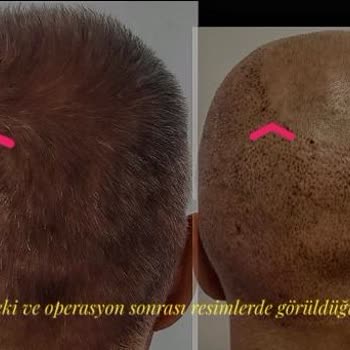 VatanMed Hair Clinic Şikayet