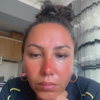 Sinoz Yüzümü Mahvetti Sizin Kusursuz Dediğiniz Ürün