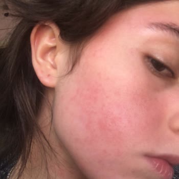 Bioderma Yüzüm Mahvoldu Yardım Edin