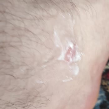 Maltepe Piazza Skechers Ayakkabı Ayak Bileğini Yaraladı