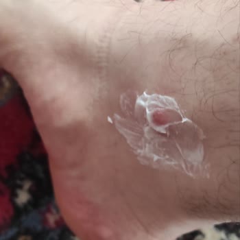 Maltepe Piazza Skechers Ayakkabı Ayak Bileğini Yaraladı